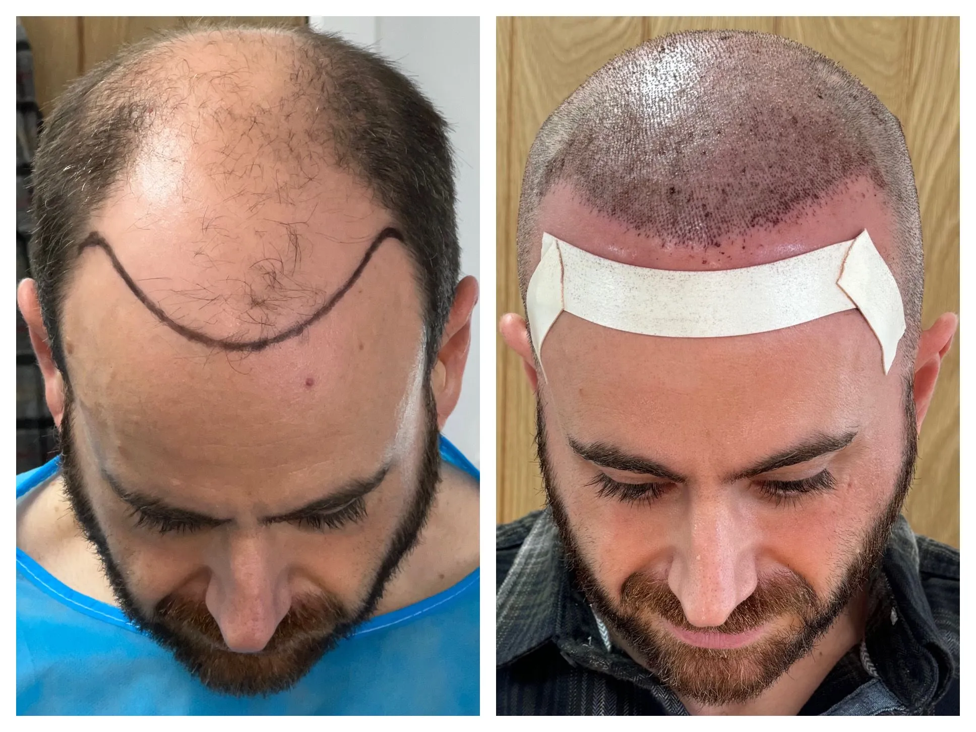 Realistic Men’s Hair Systems NYC Studio